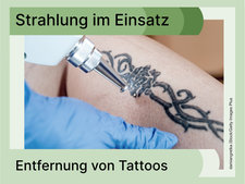 Bild von einer Tattooentfernung per Laser